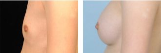 before and after of breast augmentation in chicago