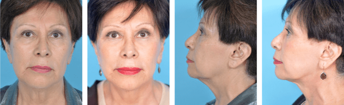 facelift-before-and-after facelift before and after from Chicago Plastic Surgery LLC